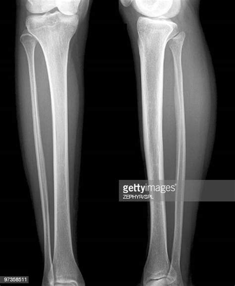 Tibia Xray Photos And Premium High Res Pictures Getty Images