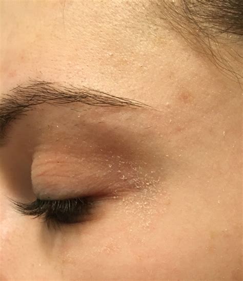 Misc Recommendations For Dry Flaky Skin Around Eyes Rskincareaddiction
