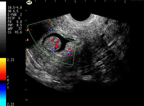 Endometriosis can affect women of any age. Endometrial Cyst