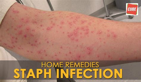 Fastest Way To Cure Staph Infection