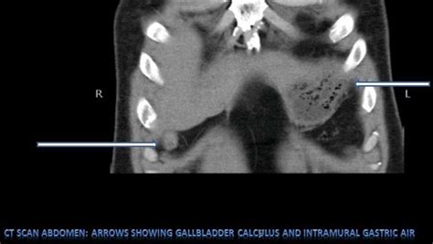 Ct Scan Abdomen Arrows Showing Gallbladder Calculas And Intramural