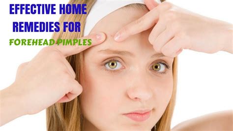 Effective Home Remedies For Forehead Pimples Youtube