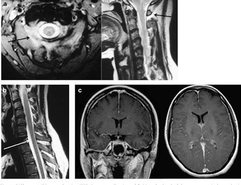 Figure 1 From Spontaneous Cervical C1 C2 Cerebrospinal Fluid Leakage