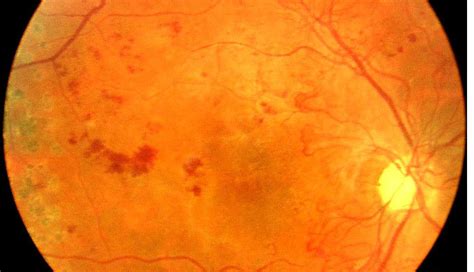 The first 2 stages of diabetic retinopathy are known as background or nonproliferative retinopathy. Diabetic retinopathy