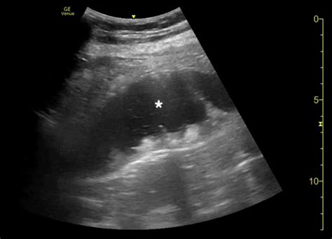 Cureus Emergency Physician Performed Bedside Ultrasound Of Gastric