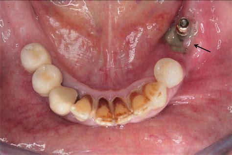 Oral Bisphosphonateassociated Osteonecrosis Of The Jaw After Implant