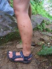 It is a rare inflammatory reaction to the mosquito's saliva. Skeeter Syndrome Pictures