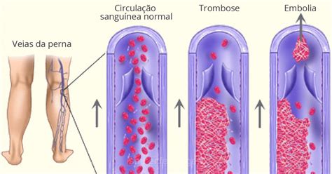 A trombose venosa profunda é a formação de um trombo, numa das veias profundas. Trombose | Trombose, Enfermagem, Trombose venosa profunda