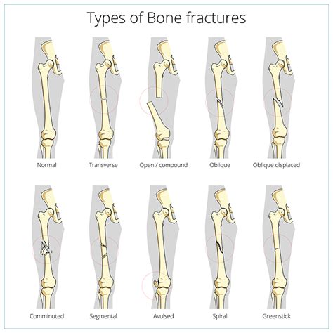 Fractures Broken Bone Fremont Orthopedic And Rehabilitation Medicine