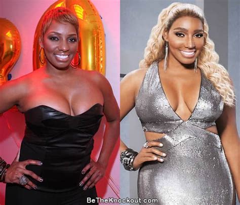 Nene Leakes Plastic Surgery Comparison Photos