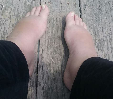 Swollen Feet Borderline Preeclampsia Picture Included Update In