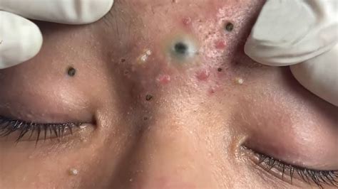 Big Cystic Acne Blackheads Extraction Blackheads And Milia Whiteheads