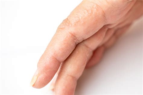 Close Up Atopic Dermatitis On Finger Also Known As Atopic Eczemaskin