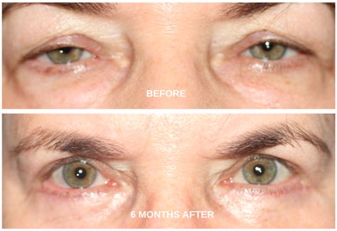 Ptosis Surgery Droopy Eyelid Repair Milan Eye Center