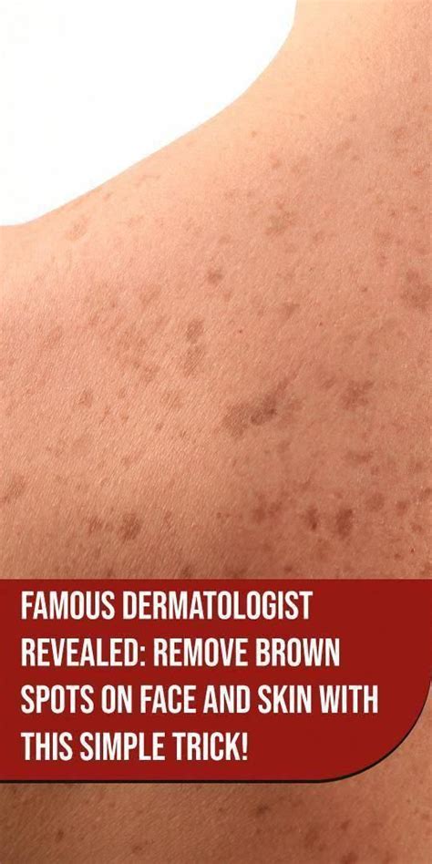 Pin On What Causes Brown Spots On Face