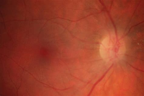 Retinal Ischemia As The First Manifestation Of Antiphospholipid