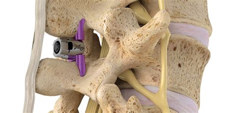 Revolutionizing The Treatment Of Spinal Stenosis In Kansas City