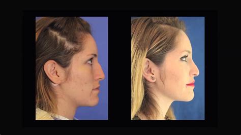 Dorsal Hump Reduction Nose Surgery To Improve Nasal Profile Graphic