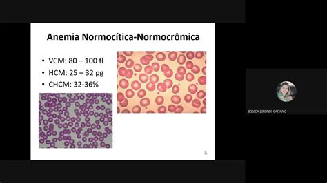 Anemia Normocromica E Normocitica