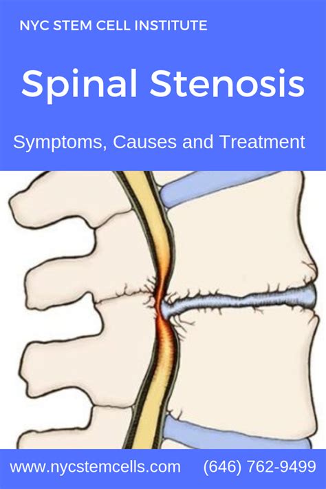 Surgery For Spinal Stenosis