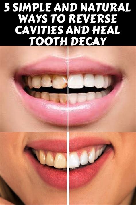 Tooth decay and cavities can be avoided, yet most of us have experienced many painful trips to the dentist. 5 Simple And Natural Ways To Reverse Cavities And Heal ...