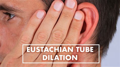 Eustachian Tube Dilation Dr Jeffrey West Top10md Youtube
