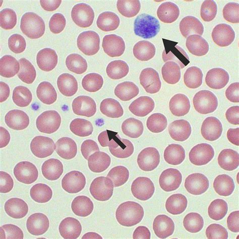 Platelet Morphology Blood Film Medschool