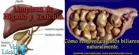 Zulia Prensa Salud Limpieza del Hígado y la vesícula Cómo remover