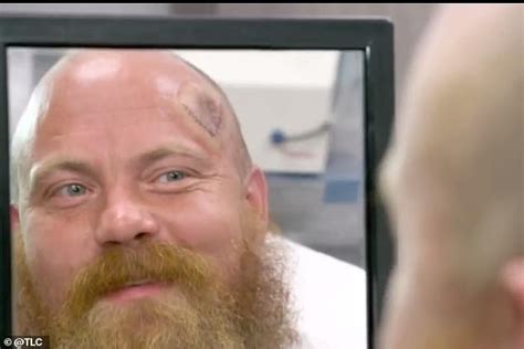 Dr Pimple Popper Squeezes Cheesy Warm Grits Out Of A Mans Head Cyst