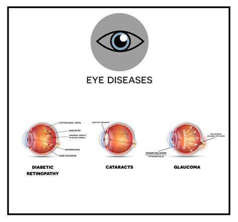 Can An Optician Detect Diabetes During An Eye Exam
