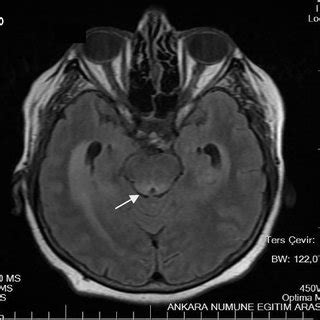 Listeriosis symptoms and signs include diarrhea, nausea, and fever. Antibiotic resistance of Listeria species isolates from ...