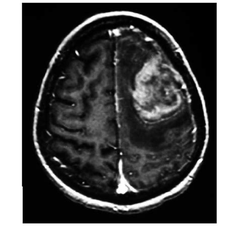 T1 Weighted Mri With Gadolinium Showing Lesion Resembling High Grade