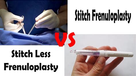 Stitchless Frenuloplasty In India Surgery For Frenulum Breve Tight
