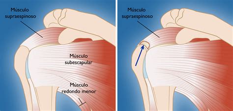 Desgarres Del Manguito De Los Rotadores Rotator Cuff Tears