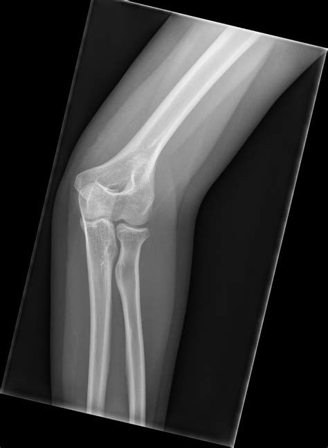 Supracondylar Spur And Radial Head Fracture Image
