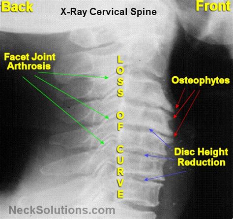 Cervical Spondylosis Symptoms And Home Treatment Options