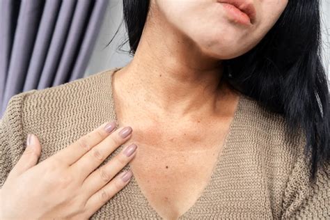 Acanthosis Nigricans Erdem Hospital And Health Group