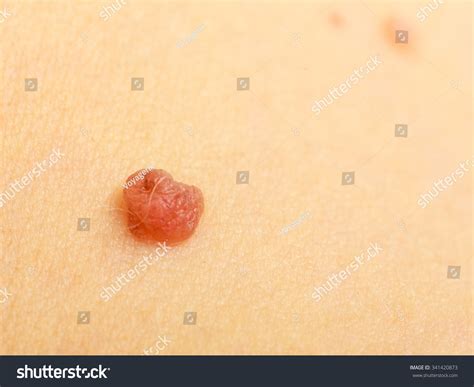 Skin Disease Closeup Brown Mole On Stock Photo 341420873 Shutterstock