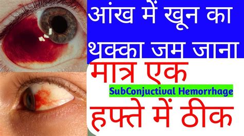 Subconjuctival Hemorrhage।red Spot In Eye।आंख में खून जम जाना।cause