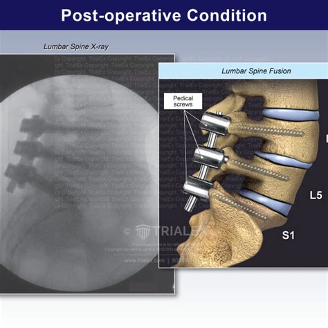 Post Operative Condition Lumbar Spine Fusion Trialexhibits Inc