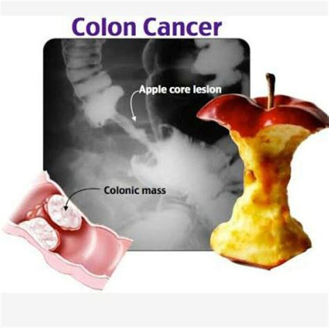 Colon Cancer Apple Core Lesion Medizzy