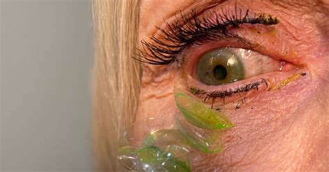 Alarming Video Shows Doctor Removing 23 Contact Lenses From Patients Eye