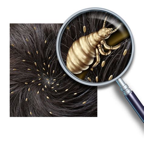 Super Lice Are A Very Real Thing — Heres How To Get Rid Of Them