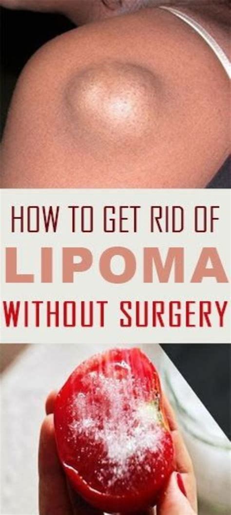 How To Get Rid Of Lipoma Without Surgery Using Natural Home Remedies