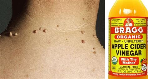 How To Use Apple Cider Vinegar For Skin Tags Ostomy Lifestyle