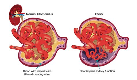 Fsgs Focus Segmental Glomerulosclerosis 치료 시장 2020 세계 연구 및 임상 분석 B