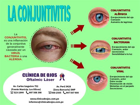 Clínica de Ojos Oftalmic Láser LA CONJUNTIVITIS