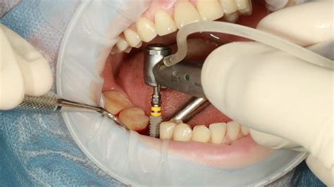 ☛ temukan berbagai jenis perawatan gigi mulai dari scaling (pembersihan gigi), tambal gigi, pasang behel (kawat gigi), veneer, operasi gigi bungsu, whitening (pemutihan gigi) dari klinik dengan fasilitas lengkap dan dokter gigi berpengalaman. Gigi Archives - The Diagnosa