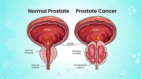 Prostate Cancer Risk Factor Symptoms Diagnosed System