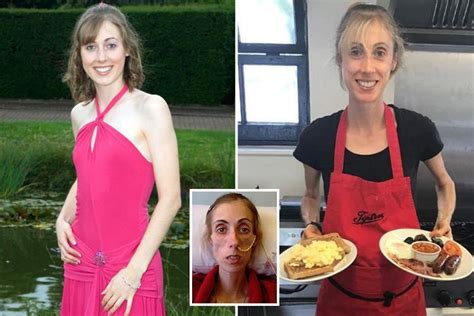 Recovering Anorexic Whose Weight Dropped To Five Stone Worked As A Chef